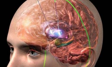 El Dr. Pablo Mortarino dio detalles de un operación trascedente para enfermos de Parkinson