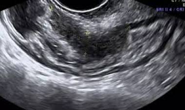 Día Mundial de la Endometriosis: Provincia capacita a los equipos de salud