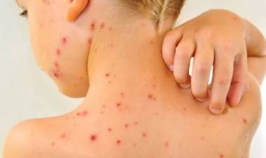 Suba de casos de sarampión y la importancia de la vacunación: "Un solo alumno puede infectar a todo un grado en una jornada"